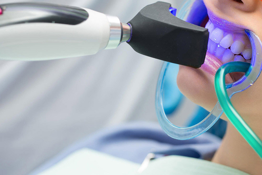 オフィスホワイトニング